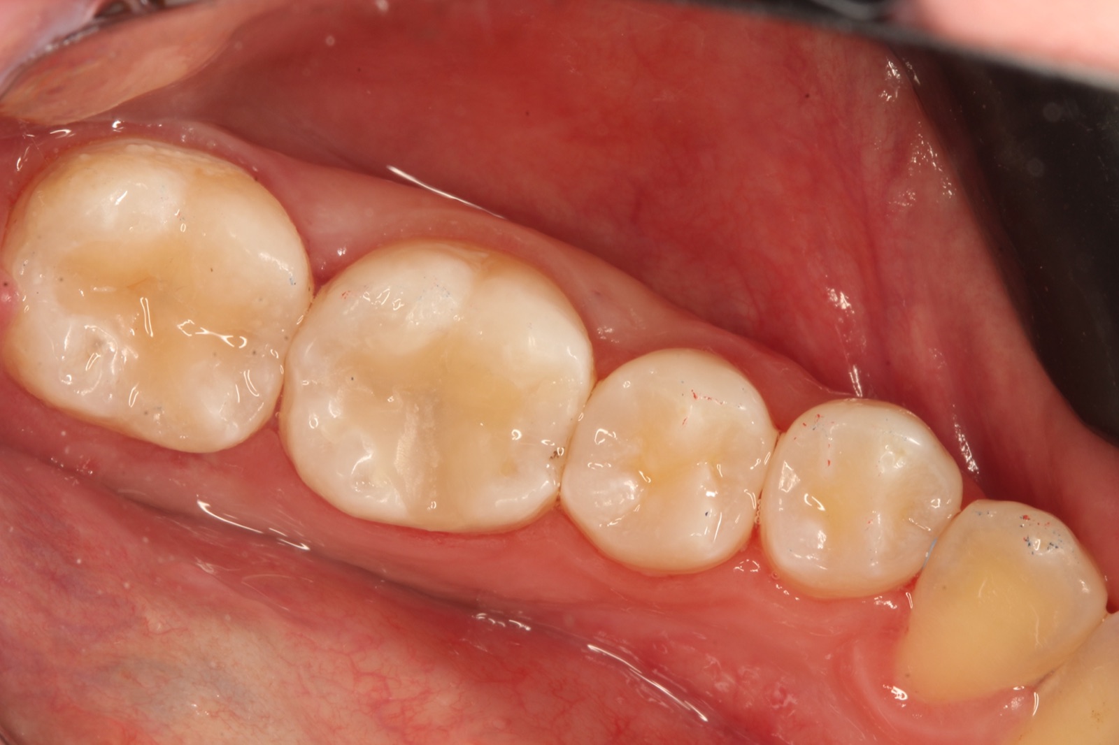 Composite Restoration — After
