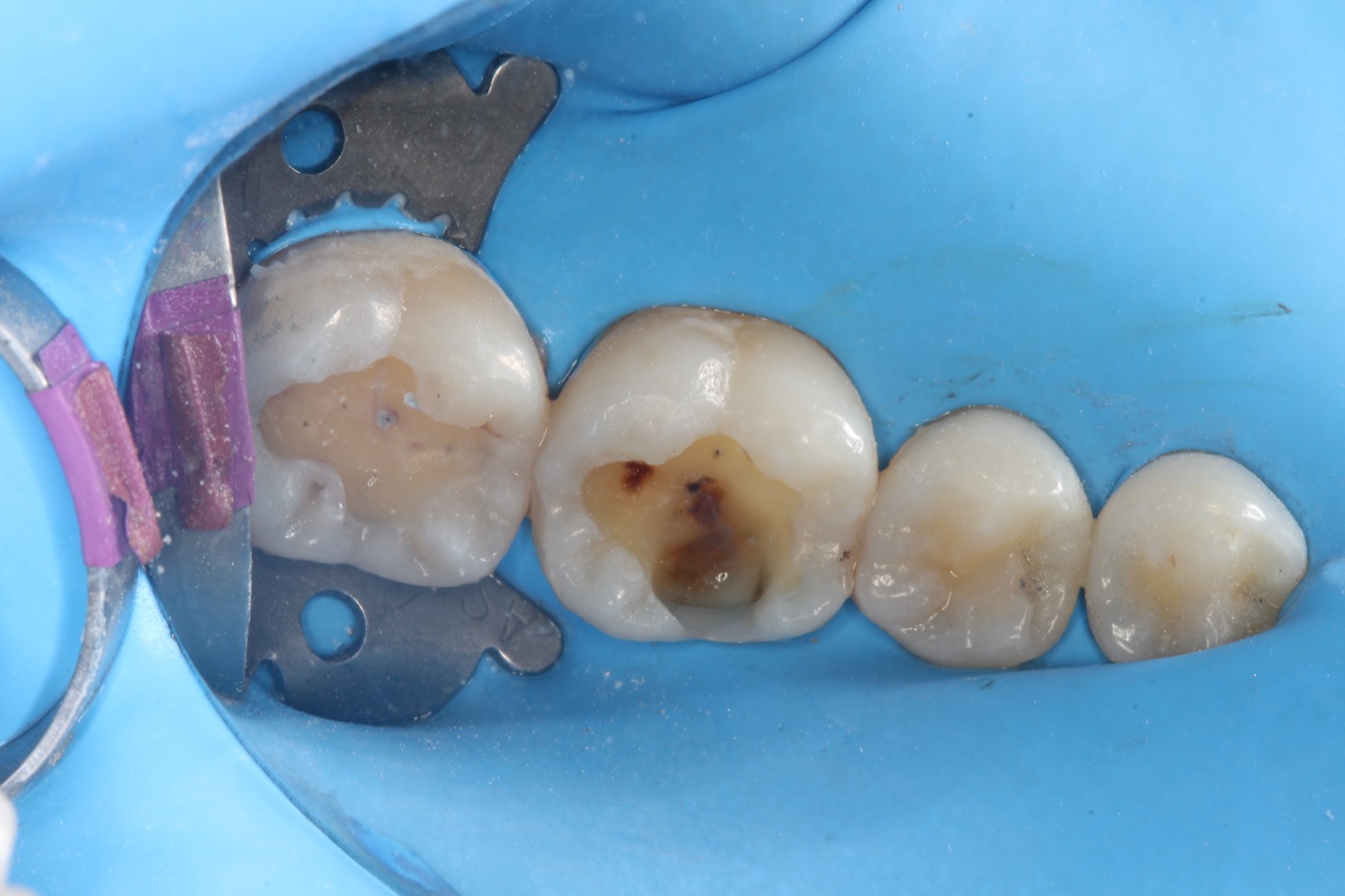 Composite Restoration — Before