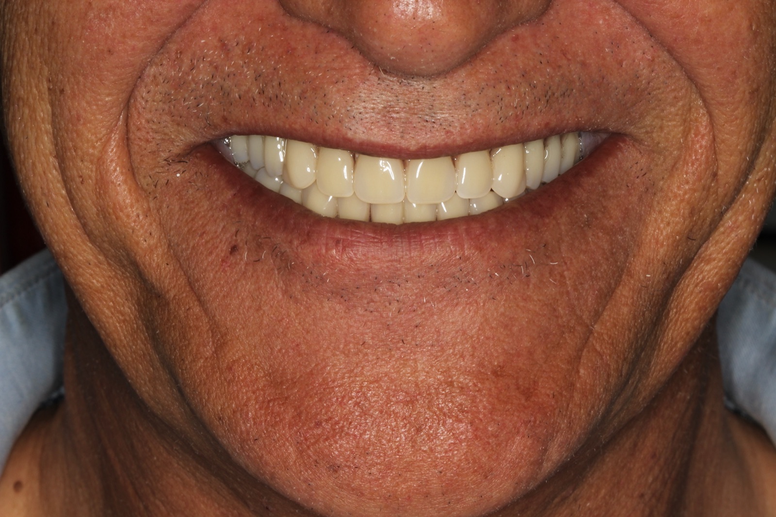 Full Mouth Rehabilitation — After