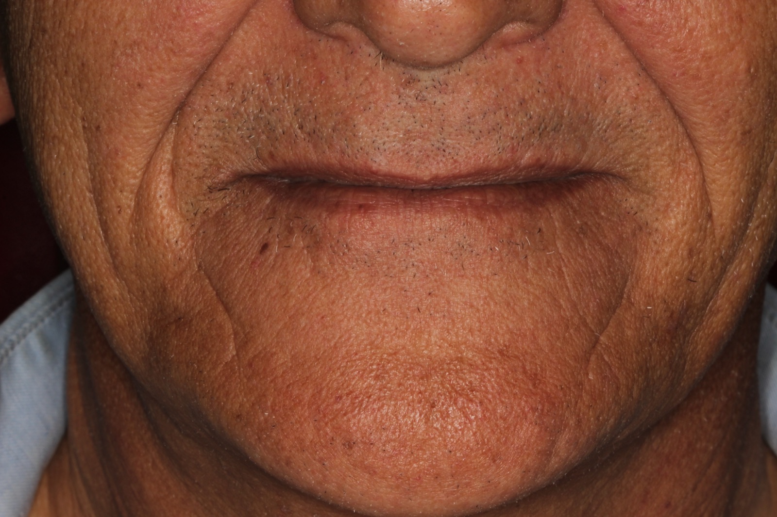 Full Mouth Rehabilitation — Before