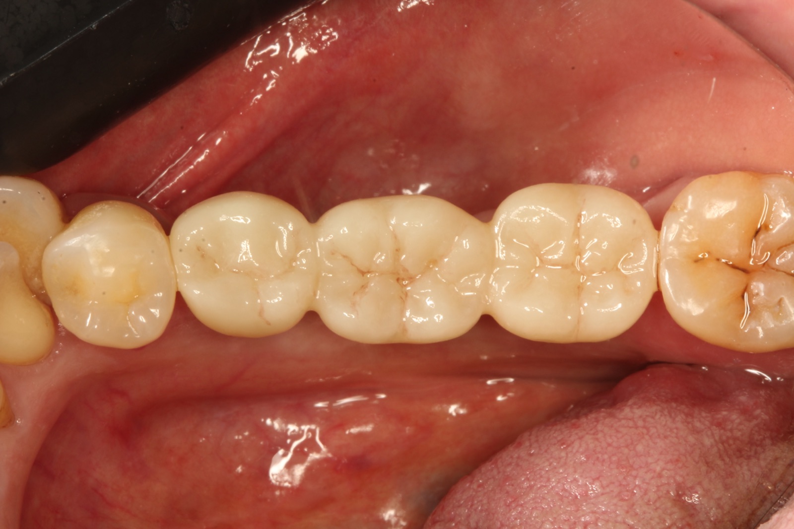 Dental Implants — After