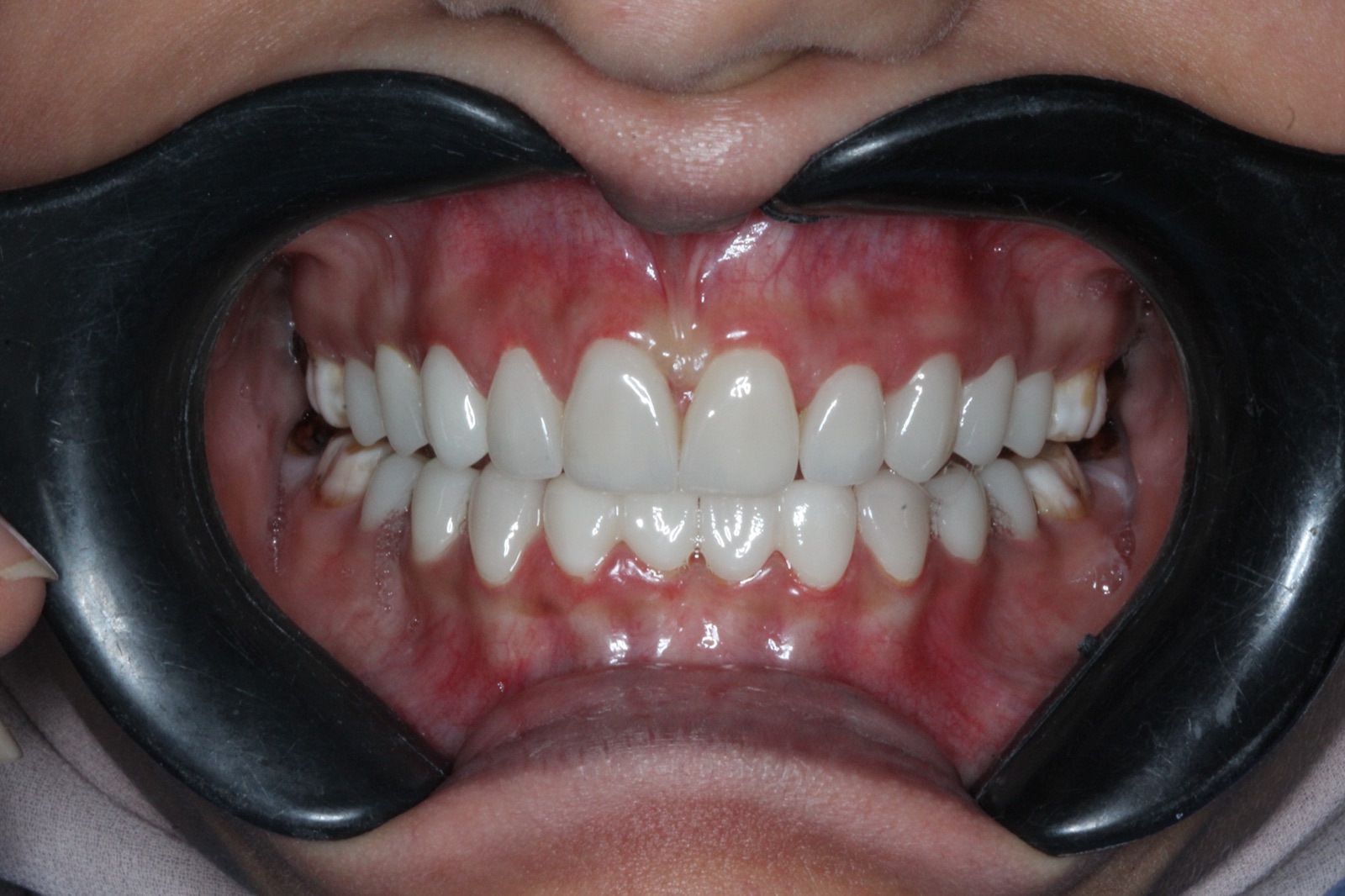Porcelain Veneers — After