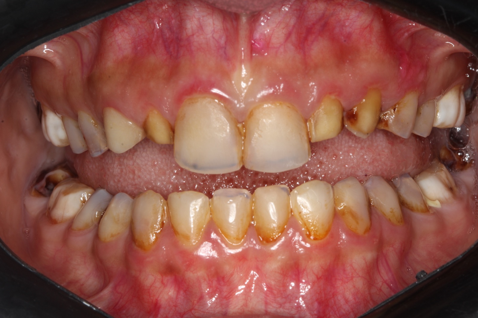 Porcelain Veneers — Before