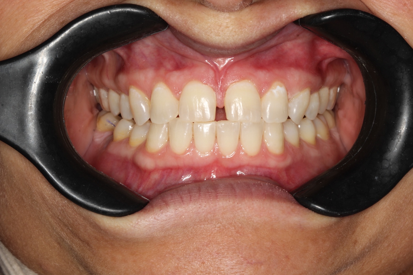 Professional Whitening — After