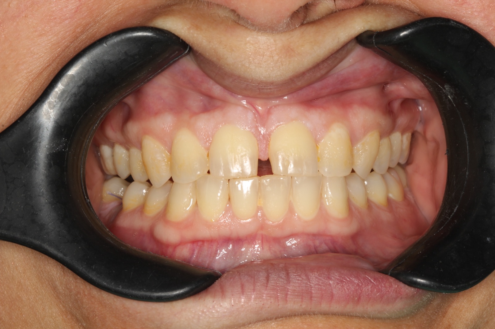 Professional Whitening — Before