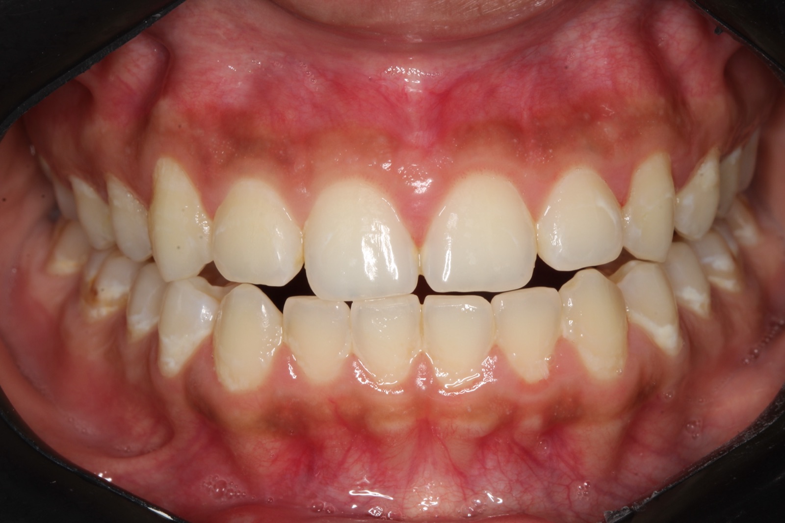 Professional Whitening — Before